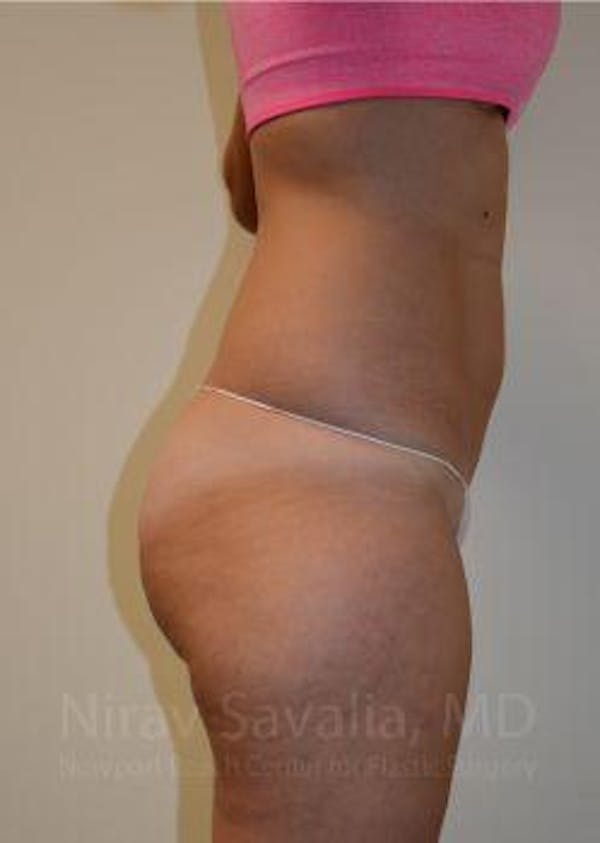 Liposuction Before & After Gallery - Patient 1655642 - Before1