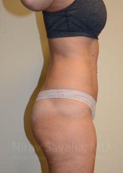 Liposuction Before & After Gallery - Patient 1655642 - After1