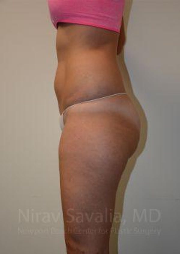 Liposuction Before & After Gallery - Patient 1655642 - Before1