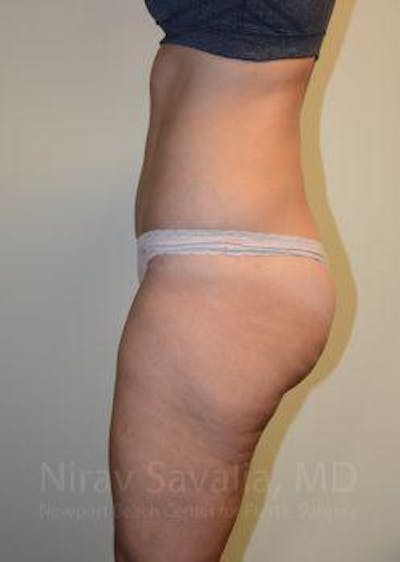 Liposuction Before & After Gallery - Patient 1655642 - After1