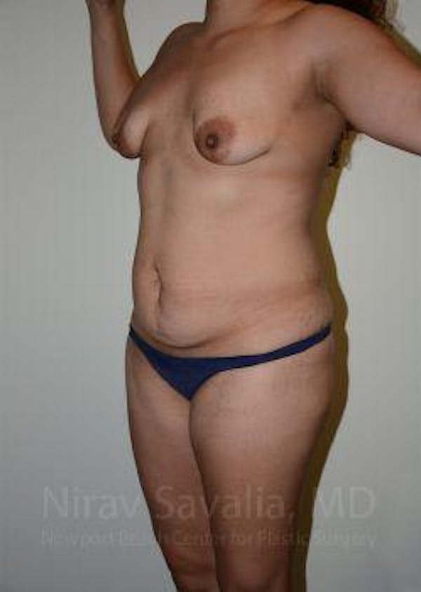 Abdominoplasty Tummy Tuck Before & After Gallery - Patient 1655641 - Before1