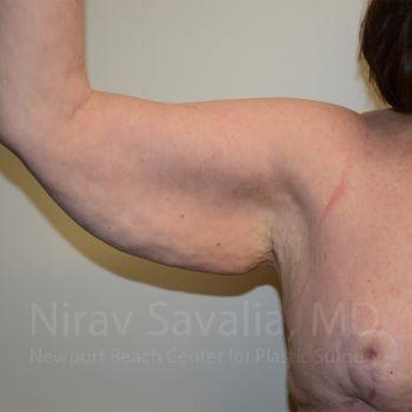 Body Contouring after Weight Loss Before & After Gallery - Patient 1655643 - Before1