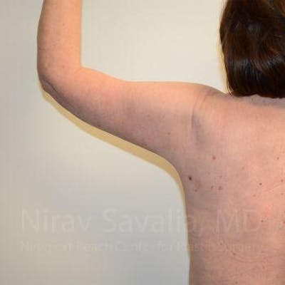 Body Contouring after Weight Loss Before & After Gallery - Patient 1655643 - After1
