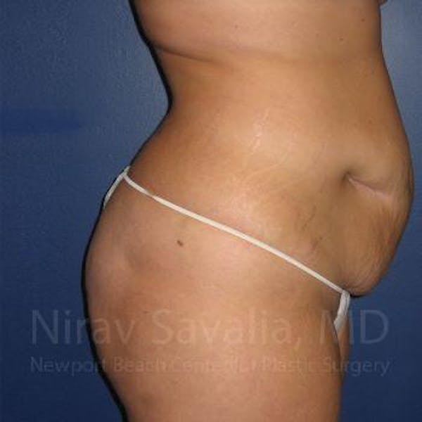 Liposuction Before & After Gallery - Patient 1655647 - Before1