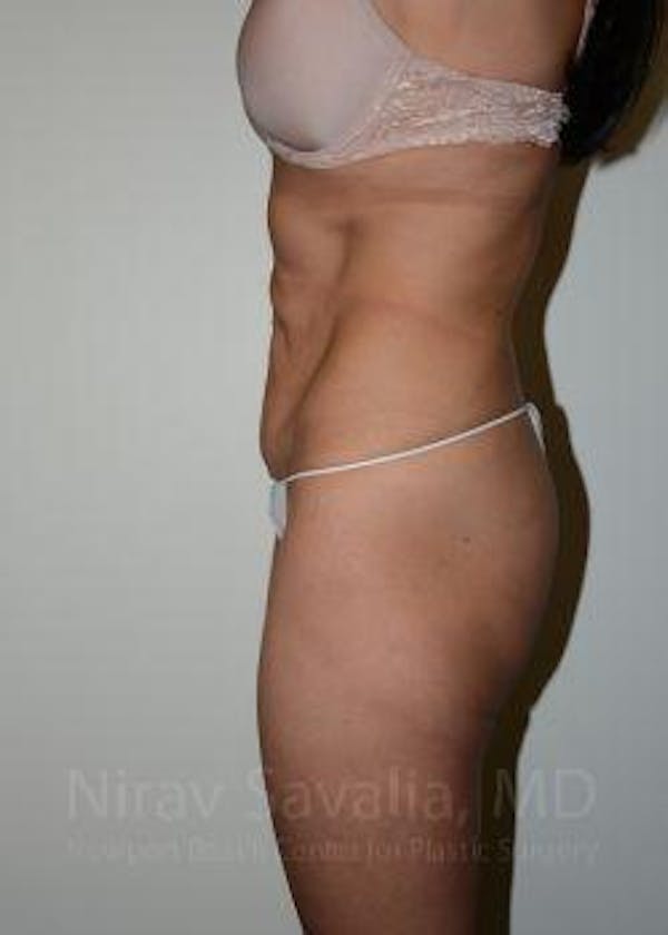 Abdominoplasty Tummy Tuck Before & After Gallery - Patient 1655645 - Before1