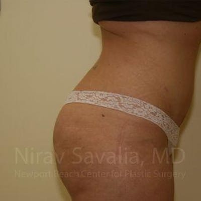Liposuction Before & After Gallery - Patient 1655647 - After1