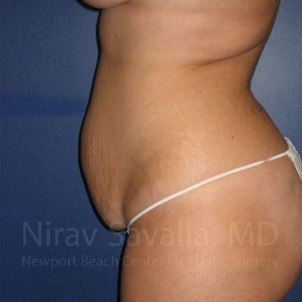 Liposuction Before & After Gallery - Patient 1655647 - Before1