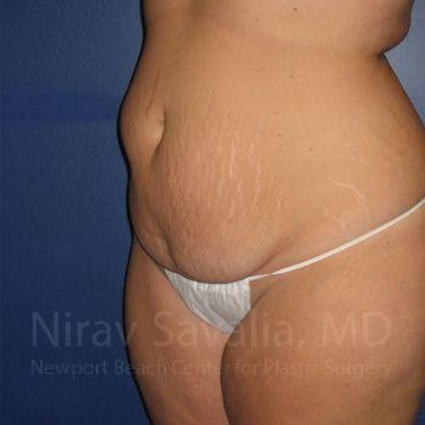 Liposuction Before & After Gallery - Patient 1655647 - Before1