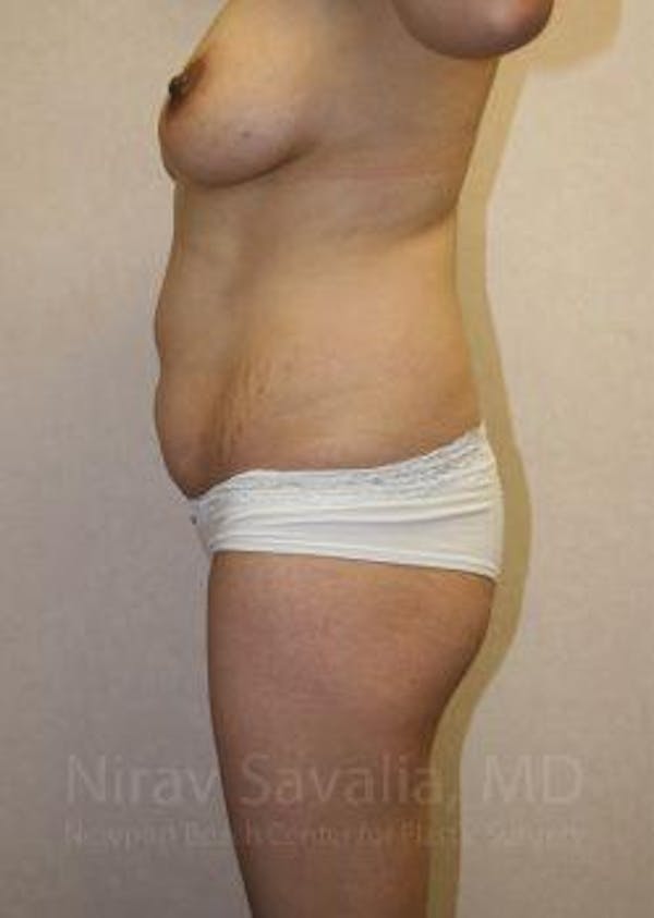 Mommy Makeover Before & After Gallery - Patient 1655648 - Before1
