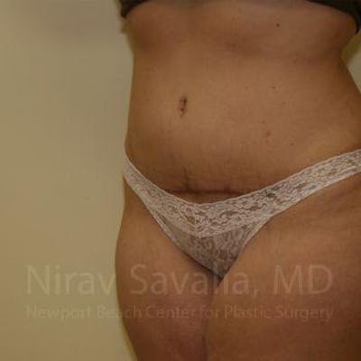 Liposuction Before & After Gallery - Patient 1655647 - After1