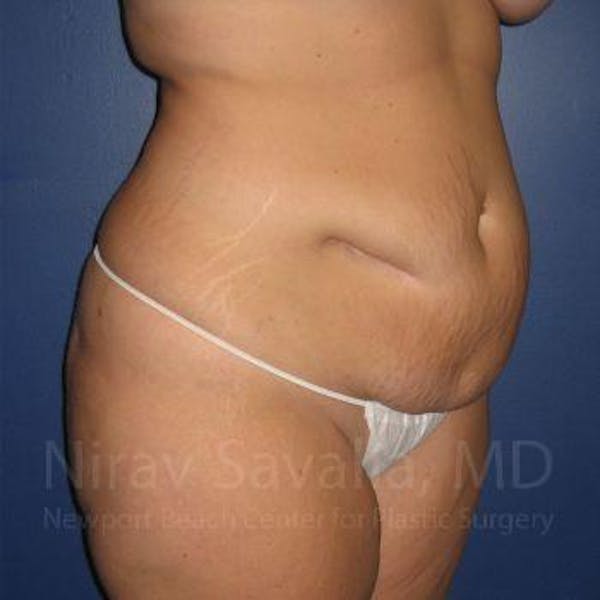 Liposuction Before & After Gallery - Patient 1655647 - Before1