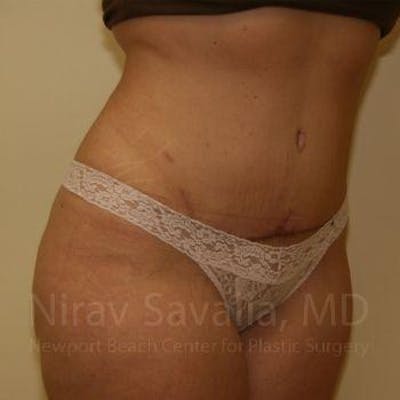 Liposuction Before & After Gallery - Patient 1655647 - After1
