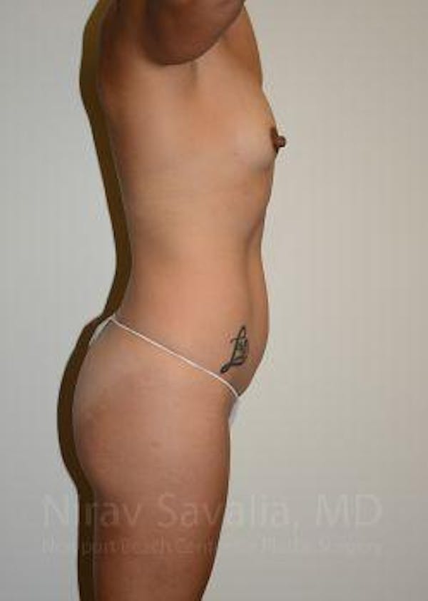 Abdominoplasty Tummy Tuck Before & After Gallery - Patient 1655653 - Before1