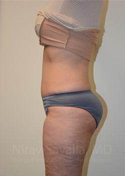 Liposuction Before & After Gallery - Patient 1655654 - After1