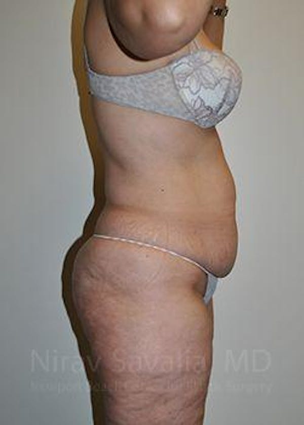 Liposuction Before & After Gallery - Patient 1655654 - Before1