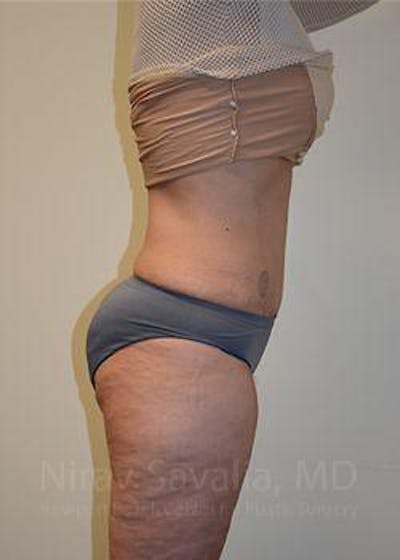 Liposuction Before & After Gallery - Patient 1655654 - After1