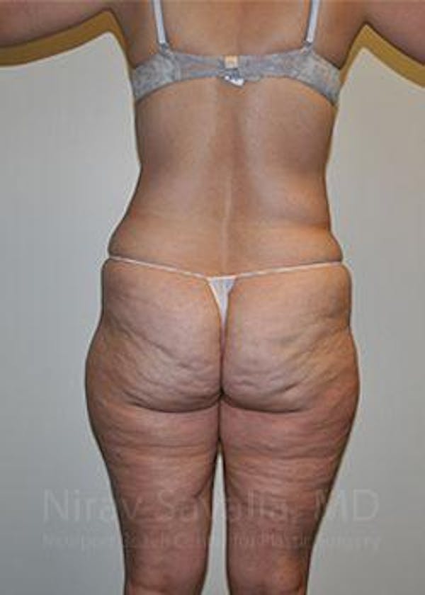 Liposuction Before & After Gallery - Patient 1655654 - Before1