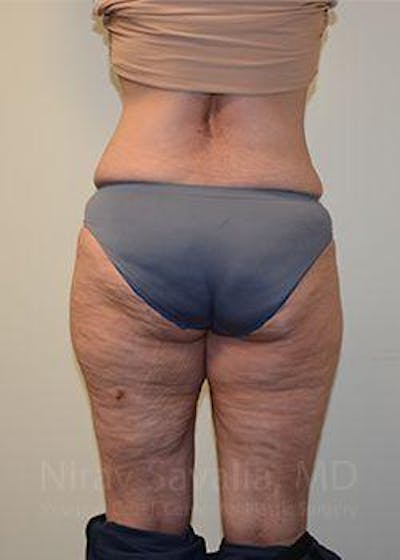 Liposuction Before & After Gallery - Patient 1655654 - After1