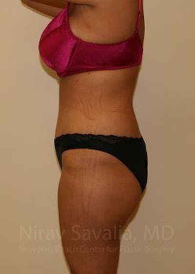 Liposuction Before & After Gallery - Patient 1655656 - After1