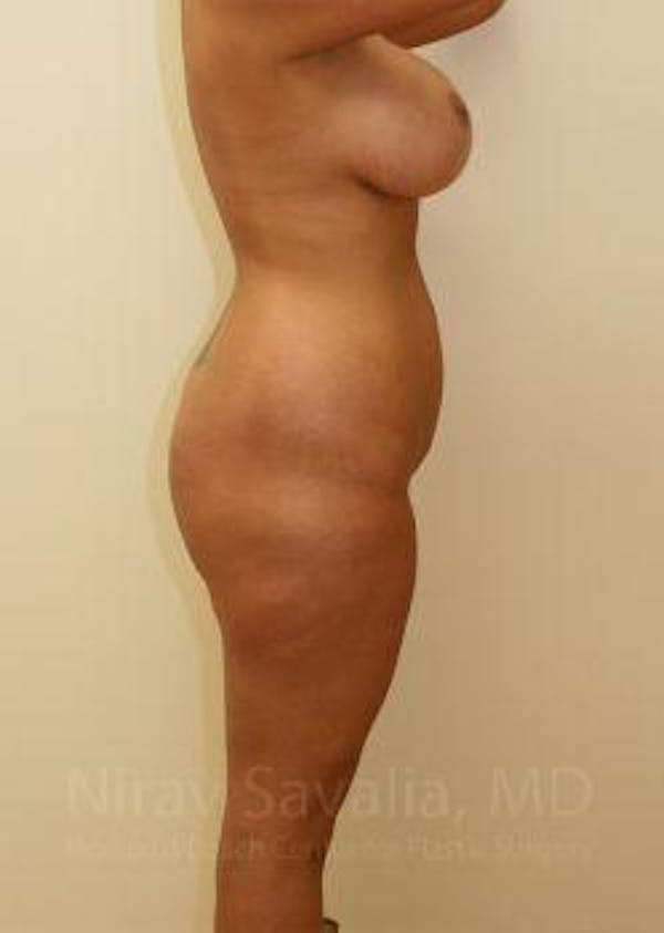 Liposuction Before & After Gallery - Patient 1655656 - Before1