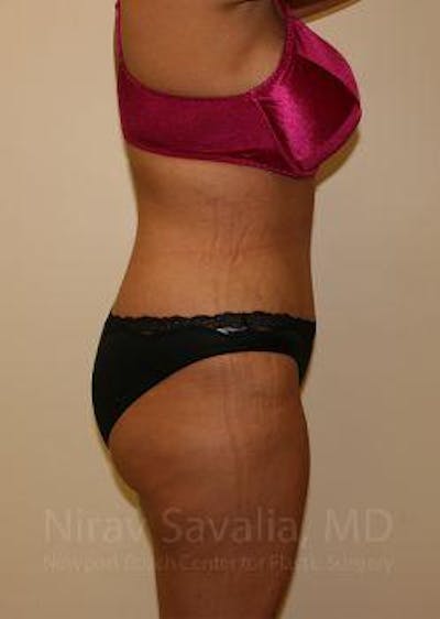 Liposuction Before & After Gallery - Patient 1655656 - After1