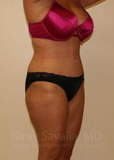 Liposuction Before & After Gallery - Patient 1655656 - After1