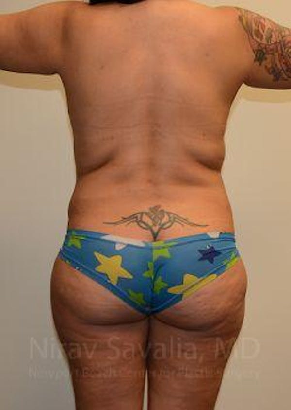 Abdominoplasty Tummy Tuck Before & After Gallery - Patient 1655657 - Before1