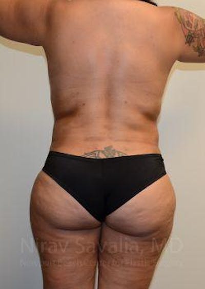 Abdominoplasty Tummy Tuck Before & After Gallery - Patient 1655657 - After1
