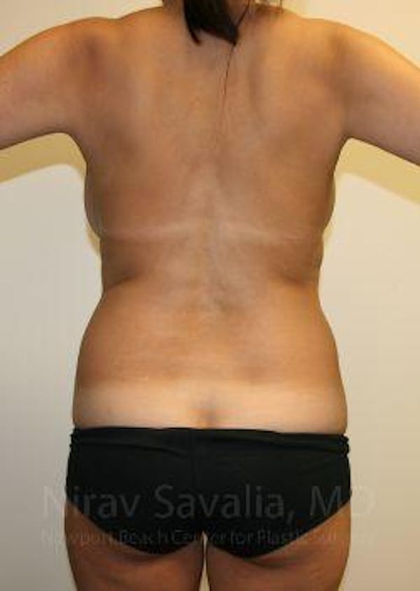 Liposuction Before & After Gallery - Patient 1655658 - Before1