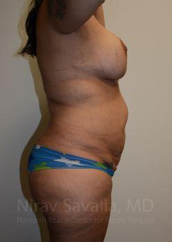 Abdominoplasty Tummy Tuck Before & After Gallery - Patient 1655657 - Before1