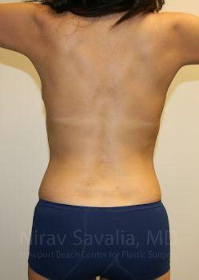 Liposuction Before & After Gallery - Patient 1655658 - After1