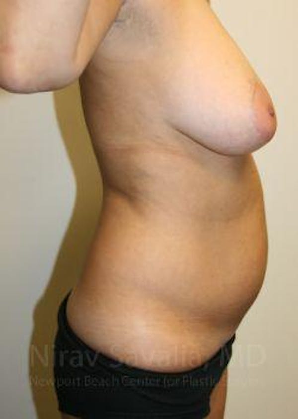 Liposuction Before & After Gallery - Patient 1655658 - Before1