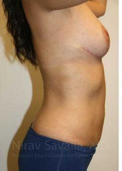 Liposuction Before & After Gallery - Patient 1655658 - After1
