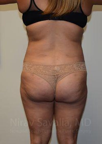 Abdominoplasty Tummy Tuck Before & After Gallery - Patient 1655659 - After1