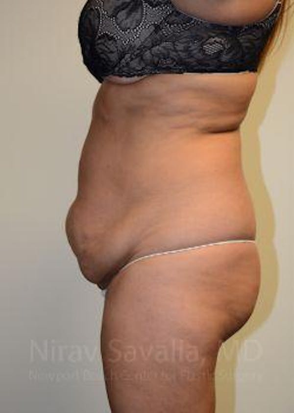 Abdominoplasty Tummy Tuck Before & After Gallery - Patient 1655659 - Before1