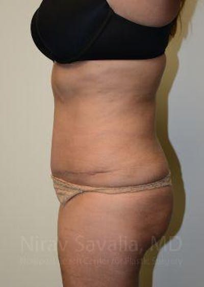 Abdominoplasty Tummy Tuck Before & After Gallery - Patient 1655659 - After1