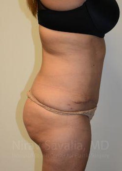 Abdominoplasty Tummy Tuck Before & After Gallery - Patient 1655659 - After1