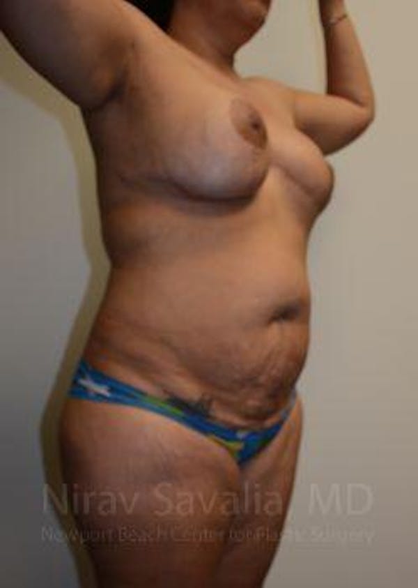 Liposuction Before & After Gallery - Patient 1655660 - Before1