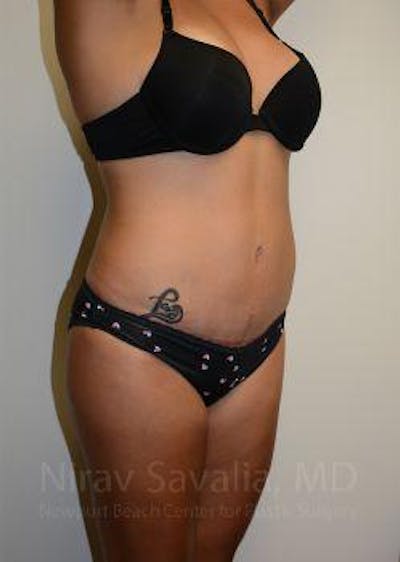 Liposuction Before & After Gallery - Patient 1655662 - After1
