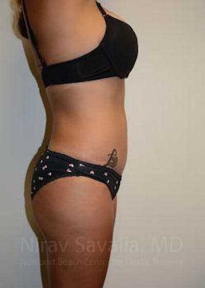 Liposuction Before & After Gallery - Patient 1655662 - After1