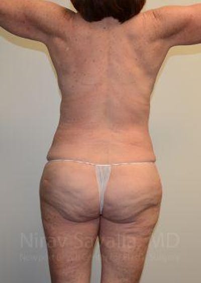 Abdominoplasty Tummy Tuck Before & After Gallery - Patient 1655663 - After1