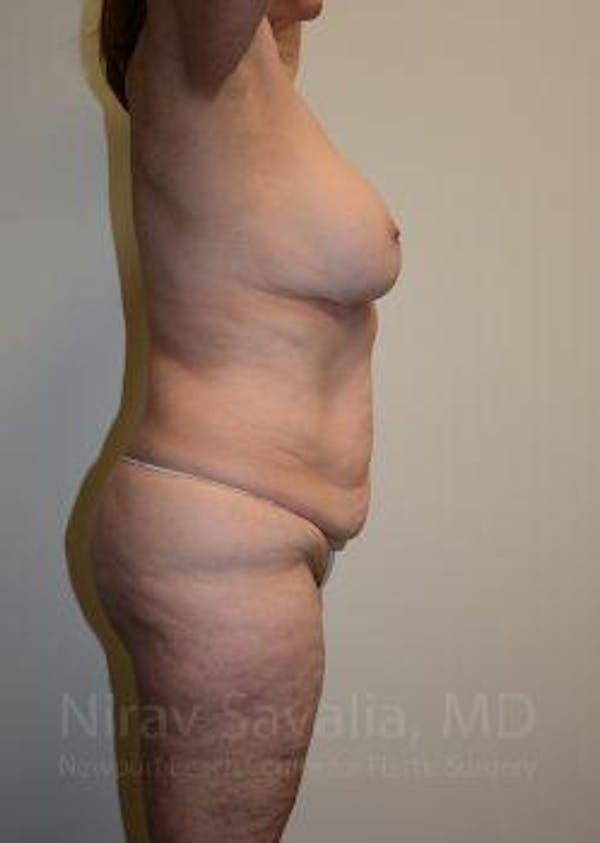 Abdominoplasty Tummy Tuck Before & After Gallery - Patient 1655663 - Before1