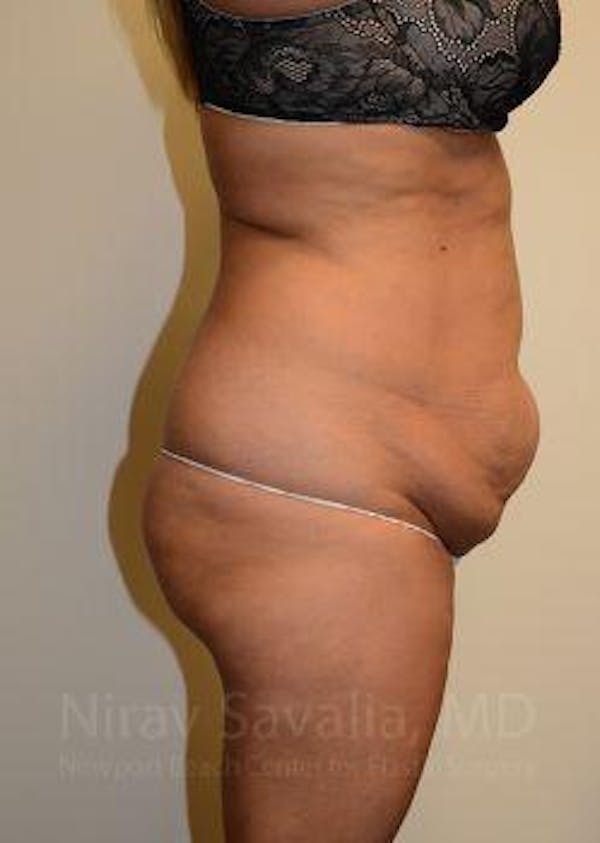Liposuction Before & After Gallery - Patient 1655664 - Before1
