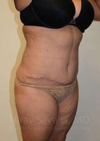 Liposuction Before & After Gallery - Patient 1655664 - After1