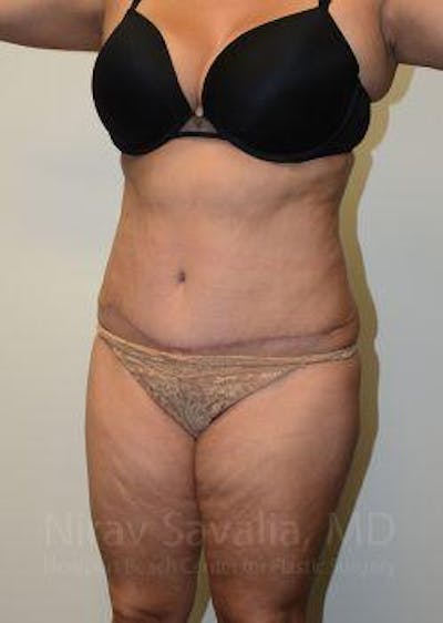 Liposuction Before & After Gallery - Patient 1655664 - After1