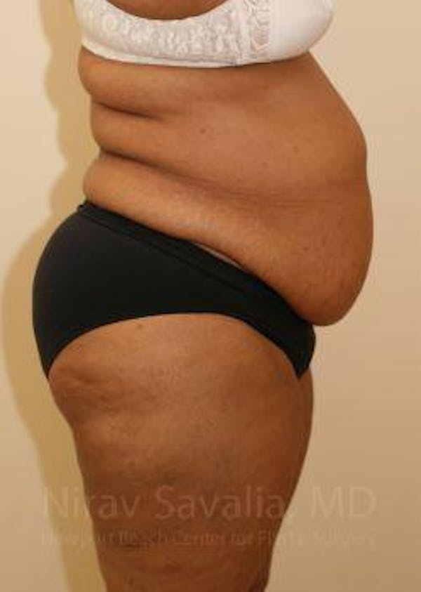 Liposuction Before & After Gallery - Patient 1655665 - Before1