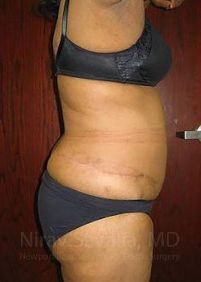 Liposuction Before & After Gallery - Patient 1655665 - After1