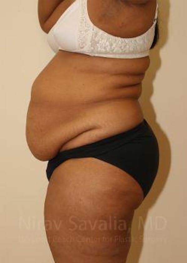 Liposuction Before & After Gallery - Patient 1655665 - Before1