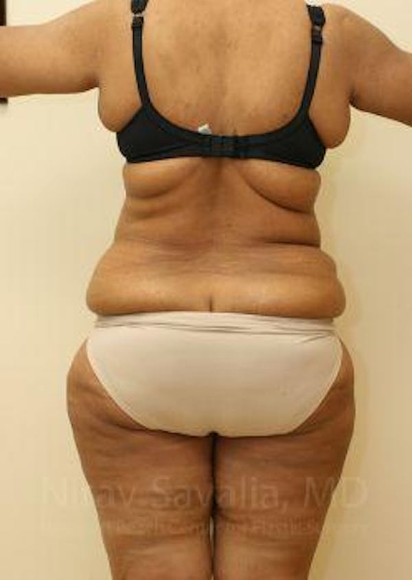 Liposuction Before & After Gallery - Patient 1655665 - Before1