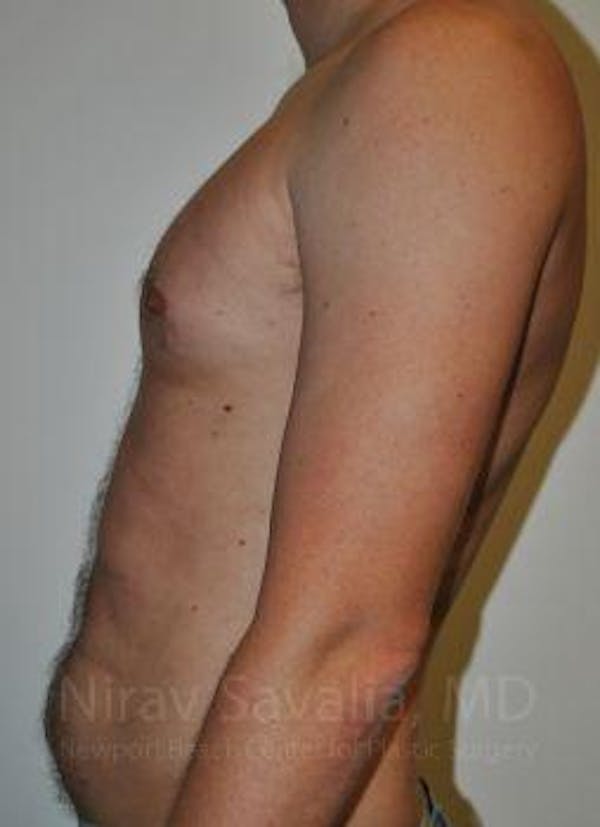 Liposuction Before & After Gallery - Patient 1655667 - Before1